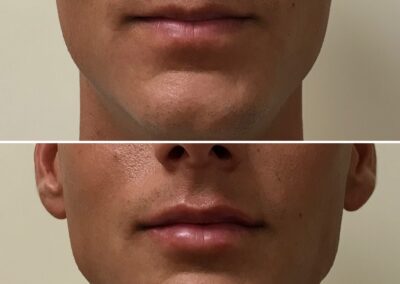 Lip Filler before and after in Glendale AZ - Cleanz Spa