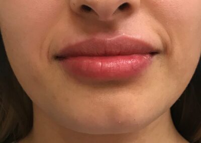Lip injections results in Phoenix AZ-Cleanz Spa