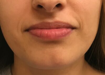 Natural lip filler results in Glendale AZ-Cleanz Spa