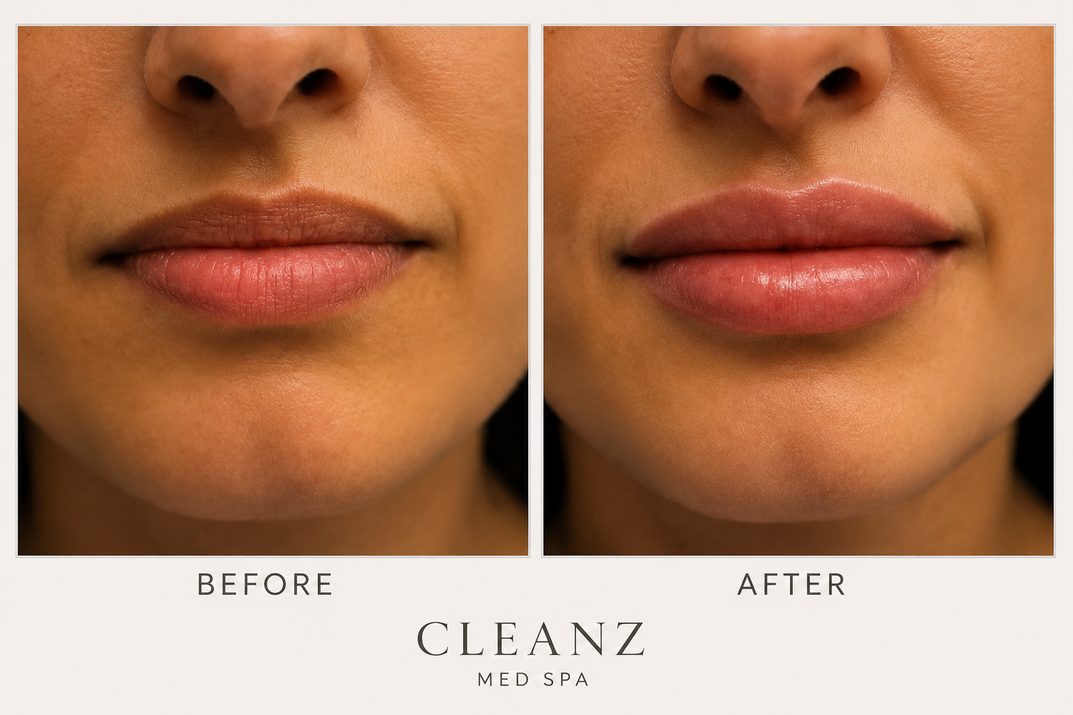 Before and after lip filler results at Cleanz Med Spa in Glendale, AZ showing fuller, natural-looking lips. 